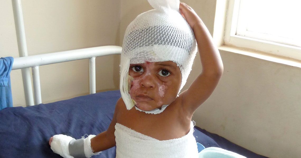 A child with burn scars on their face and medical wrapping on their head, body and hand