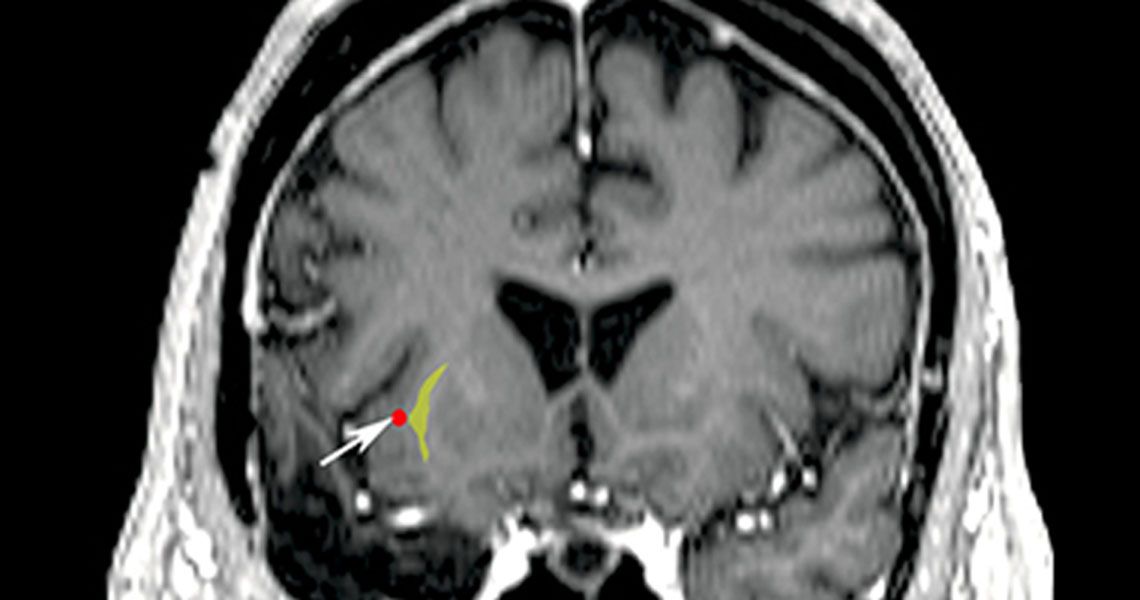 Brain scan showing highlighted left claustrum