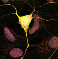 Motor neuron with dendrites and axons (yellow) and mutant protein aggregates (red) among undifferentiated stem cells