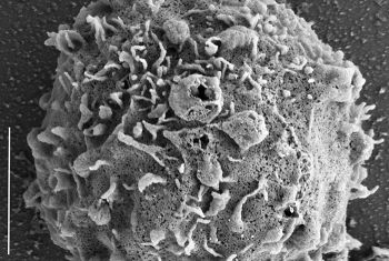 A natural killer cell with iron oxide particles on its surface as seen under an electron microscope