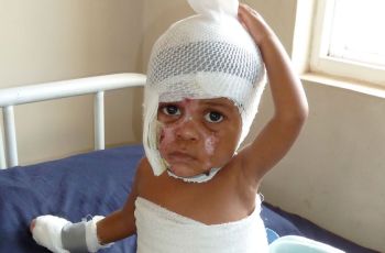A child with burn scars on their face and medical wrapping on their head, body and hand