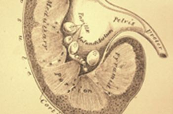 A kidney diagram illustrating kidney stones