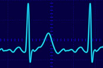 Waveform lines from a heart monitor reading